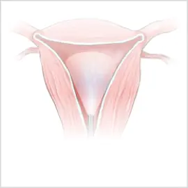 Hysteroscopy