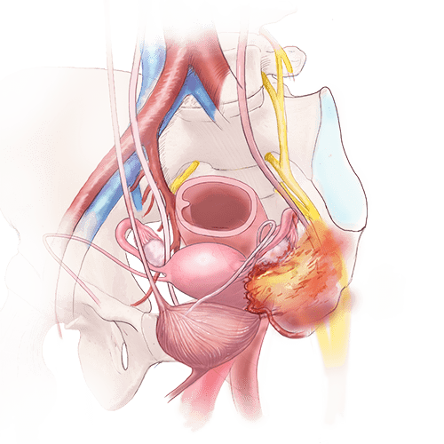 Other types of deep endometriosis (DE)
