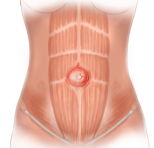 Primary ventral hernia (PVH)