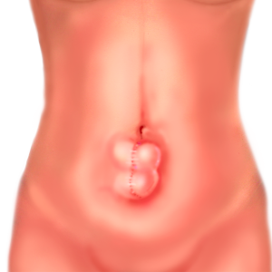 Incisional hernia
