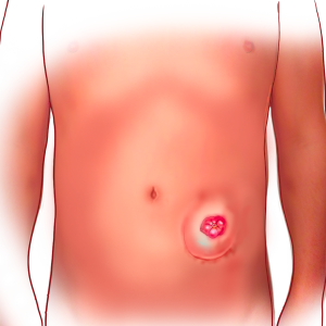 Parastomal hernia