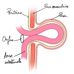 Considerations in hernia repair