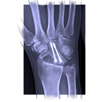 Osteoarthritis and arthrodesis